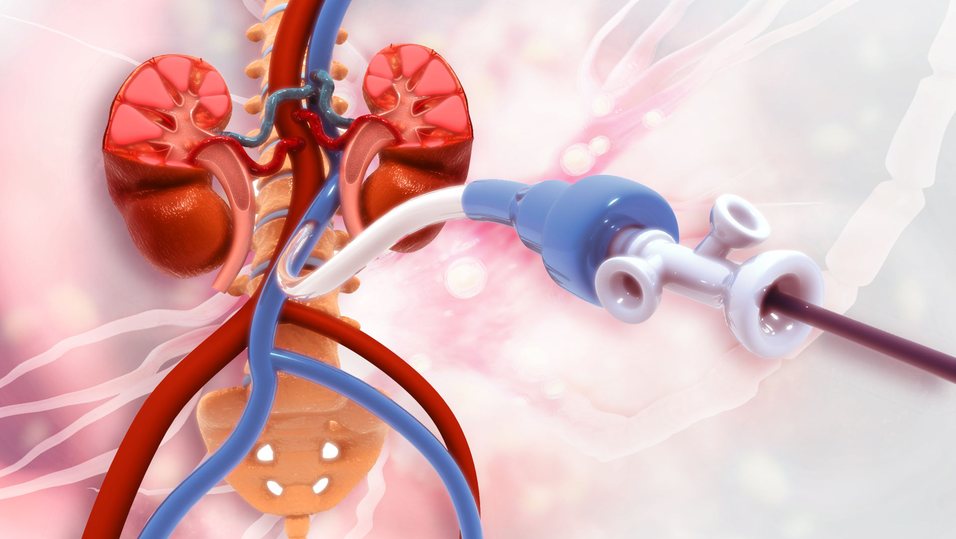 Dialysis Catheter